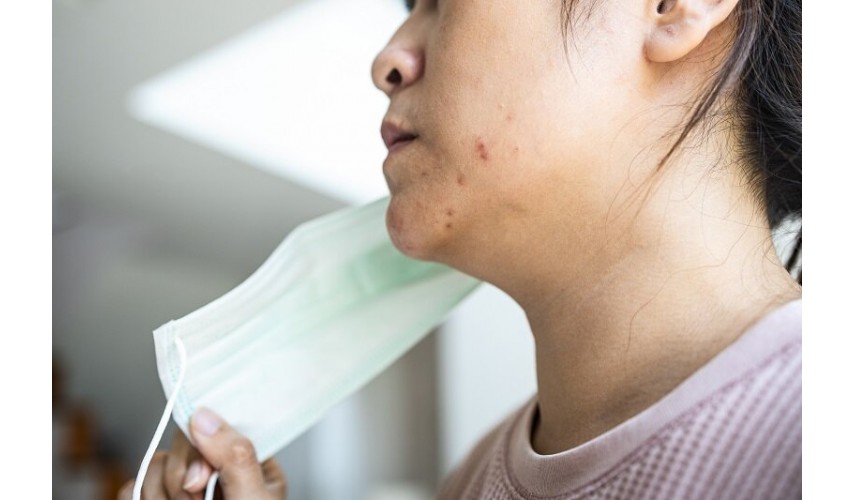 Acne in times of pandemic