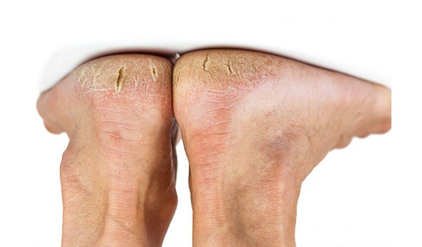 How to remove cracked heels without toxicity