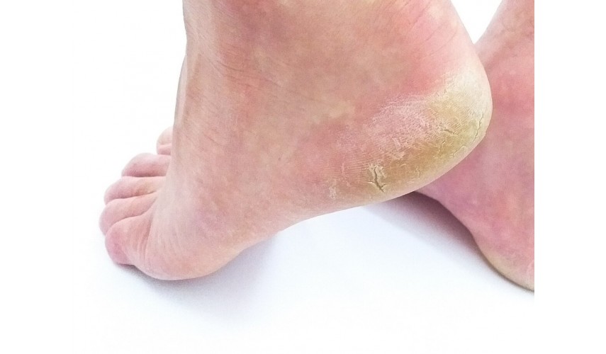 ¿Qué tengo en el pie, un hongo o virus?