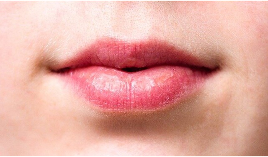 Chapped lips: how to care for them